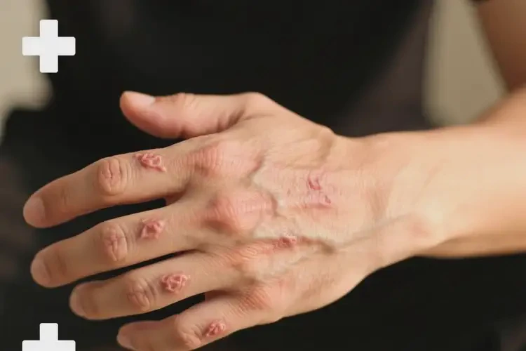 男人手上長(zhǎng)濕疹能徹底自愈嗎(圖1)