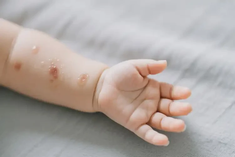 宝宝手臂上长湿疹可不可以根治(图1)