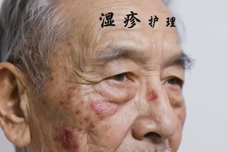 老人臉上容易起濕疹不管它會自己痊愈嗎(圖4)