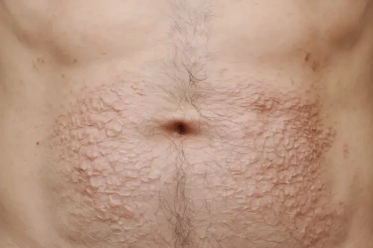 男人肚子上偶爾長濕疹可以徹底自愈嗎(圖2)