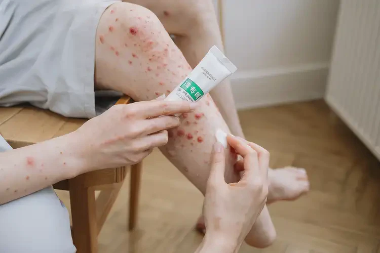 女生小腿上經(jīng)常長濕疹不管它會自己痊愈嗎(圖3)