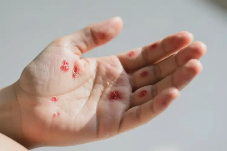 產(chǎn)婦手上長濕疹不管它會自己好嗎(圖3)