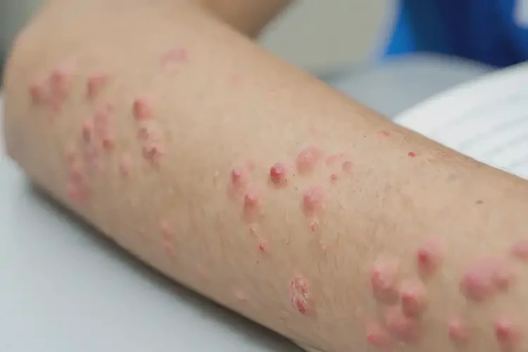 中學(xué)生屁股有濕疹不管它會(huì)自己自愈嗎(圖4)