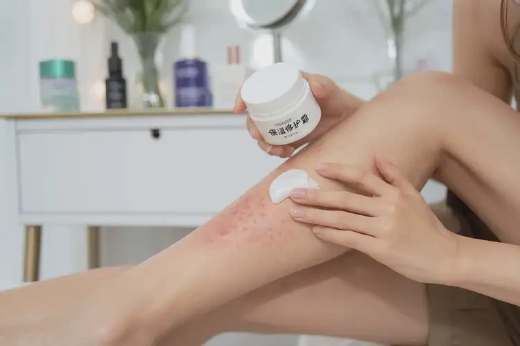 女生全身偶爾長(zhǎng)濕疹不管它會(huì)自己痊愈嗎(圖3)