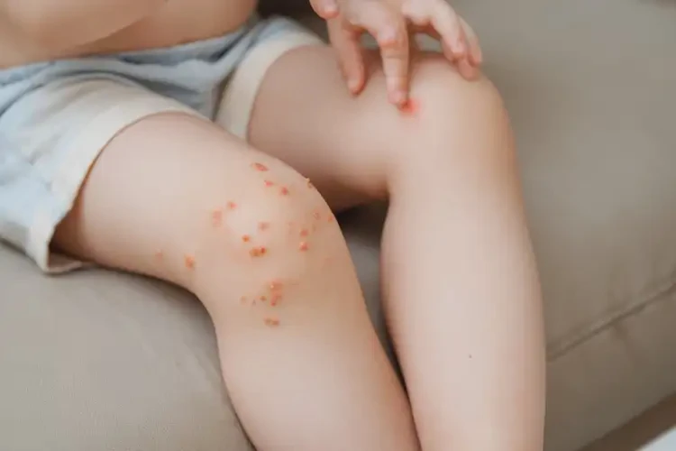 小孩大腿出濕疹不管它會自己痊愈嗎(圖4)