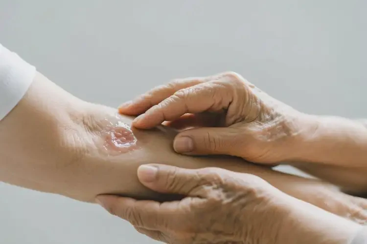 老年人手臂有湿疹不管它会自己自愈吗(图3)