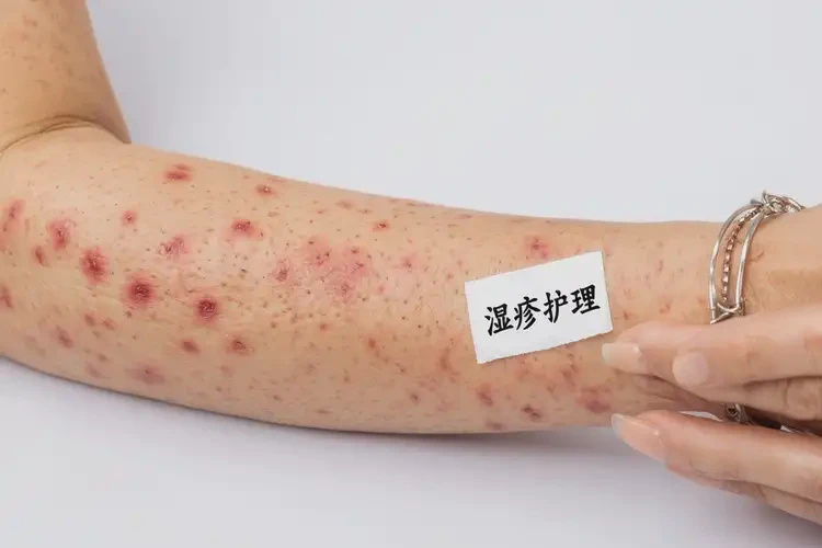 女人手臂上長濕疹不管它會(huì)自己痊愈嗎(圖4)