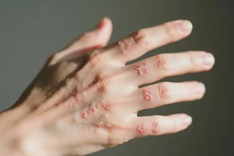 女生手上起濕疹可以徹底自愈嗎(圖3)
