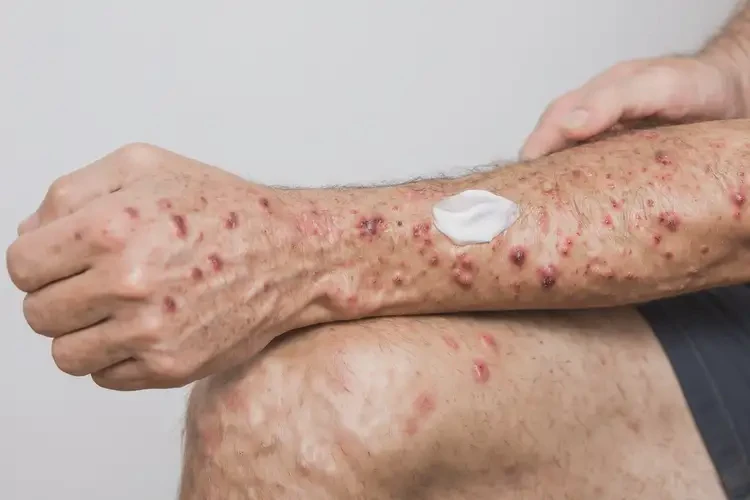 男性四肢容易長濕疹不管它會自己自愈嗎(圖3)