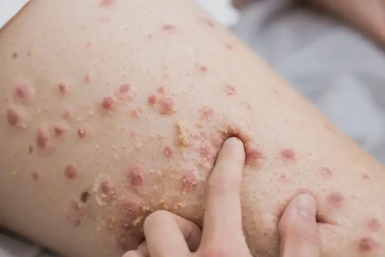 孕婦小腿出濕疹能徹底自愈嗎(圖4)