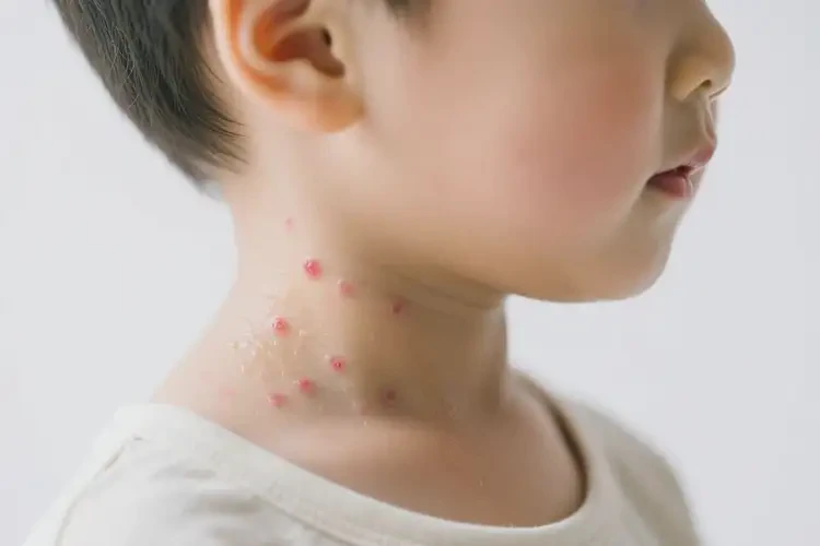 小孩脖子偶爾起濕疹可不可以根治(圖3)