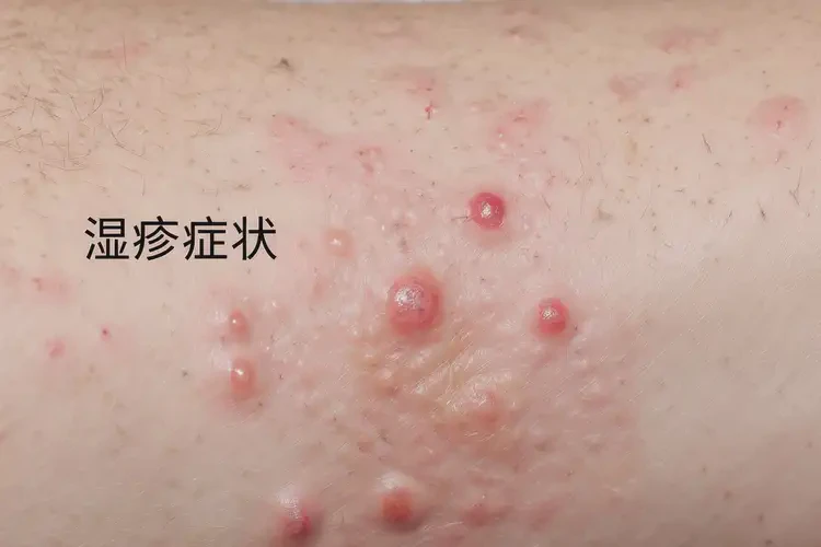 女人手臂經常起濕疹不管它會自己自愈嗎(圖4)