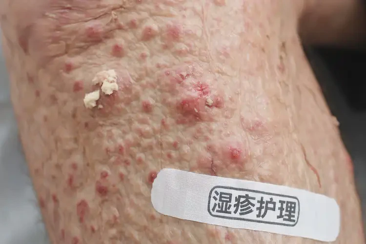 老年人小腿上容易长湿疹能彻底自愈吗(图4)