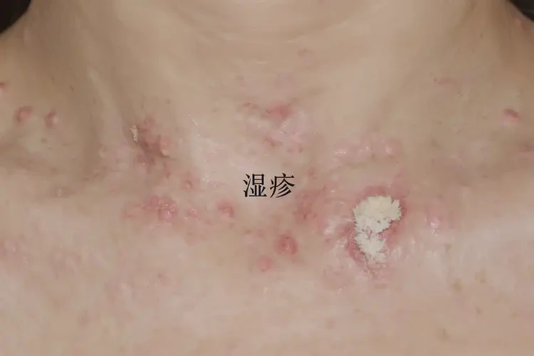 女性脖子上出濕疹能夠徹底治愈嗎(圖4)