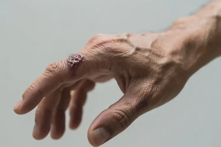 男人手上長濕疹能不能根治(圖2)