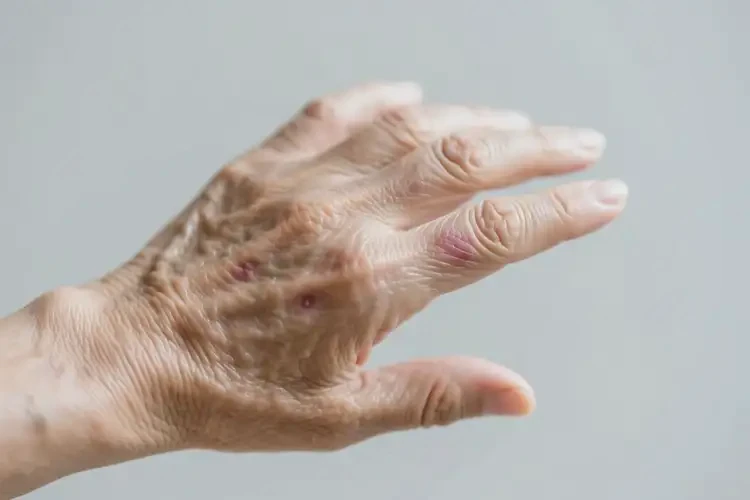 老人手上出濕疹能夠徹底治愈嗎(圖3)