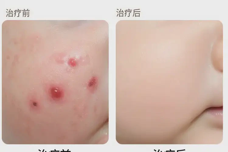 新生兒肛周長濕疹不管它會自己痊愈嗎(圖1)