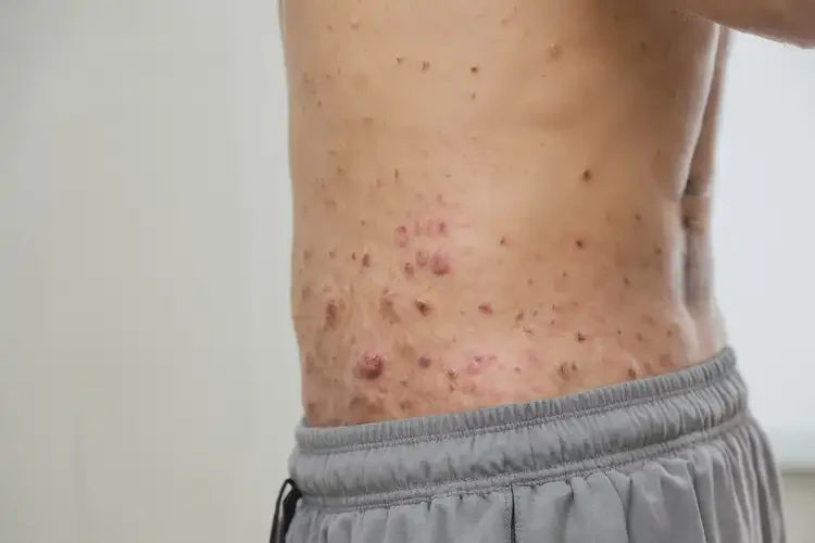 青年人屁股有濕疹可以徹底自愈嗎(圖4)