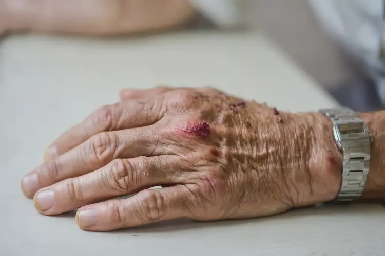 老年人手上偶爾長(zhǎng)濕疹不管它會(huì)自己好嗎(圖4)