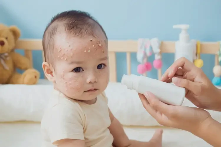 嬰兒臉上經常起濕疹不管它會自己好嗎(圖3)