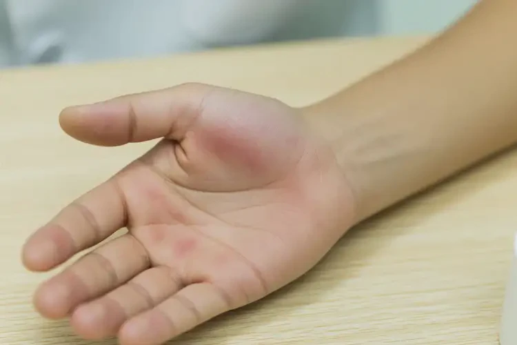 男生手上出濕疹可不可以徹底自愈(圖3)