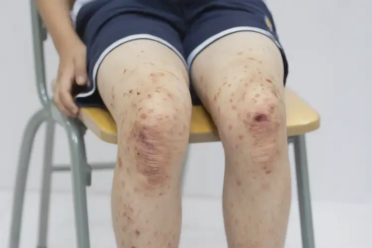 中学生大腿上出现湿疹不管它会自己痊愈吗(图2)