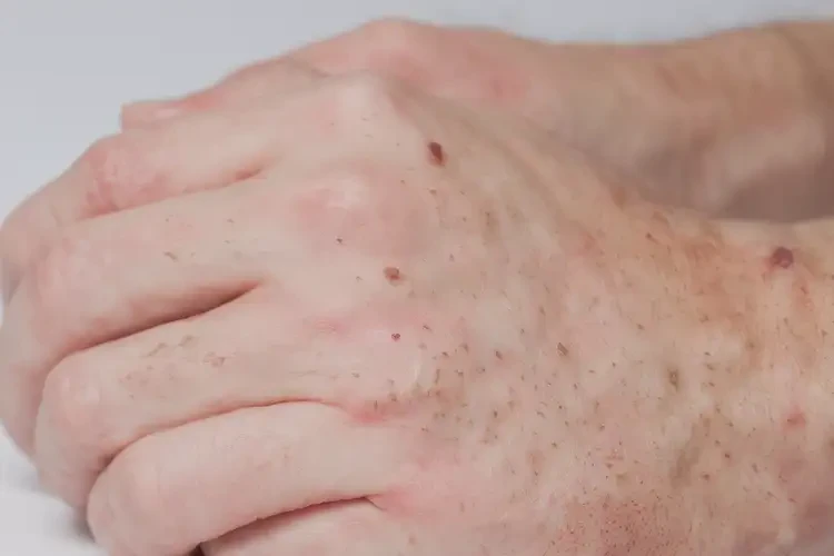 青年人屁股起湿疹可不可以彻底自愈(图4)