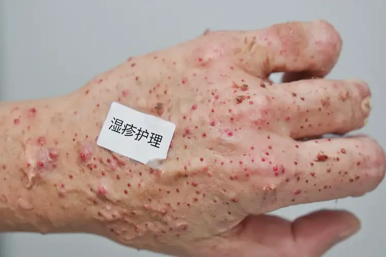 大學生手上出濕疹不管它會自己自愈嗎(圖4)