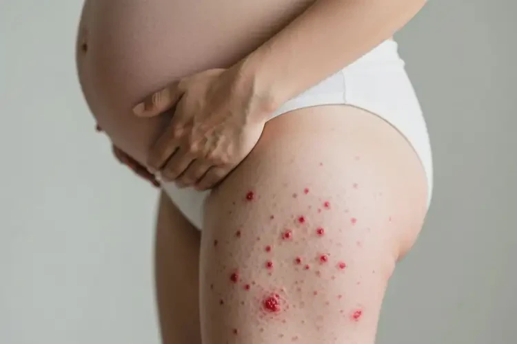 產(chǎn)婦小腿上容易起濕疹能徹底自愈嗎(圖2)