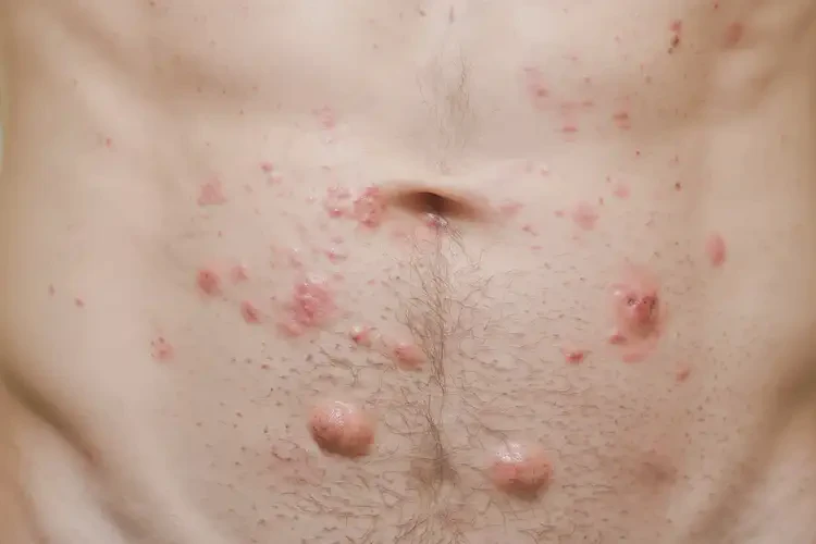 青年人肚子上起濕疹能夠徹底治愈嗎(圖4)