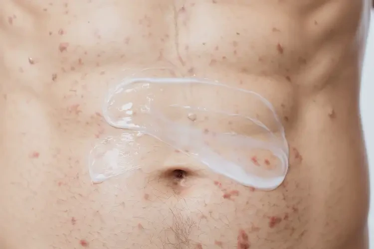 男性肚子偶爾起濕疹可以徹底自愈嗎(圖2)