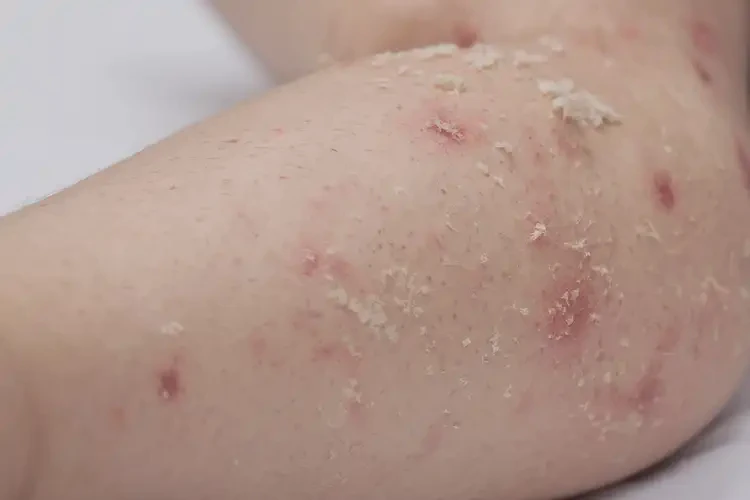 兒童小腿出現(xiàn)濕疹可不可以徹底自愈(圖4)