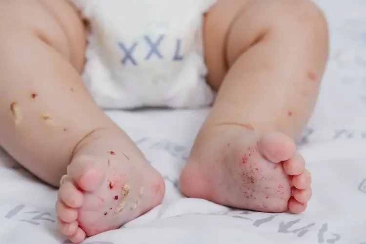 嬰兒腳上出濕疹可不可以徹底自愈(圖2)