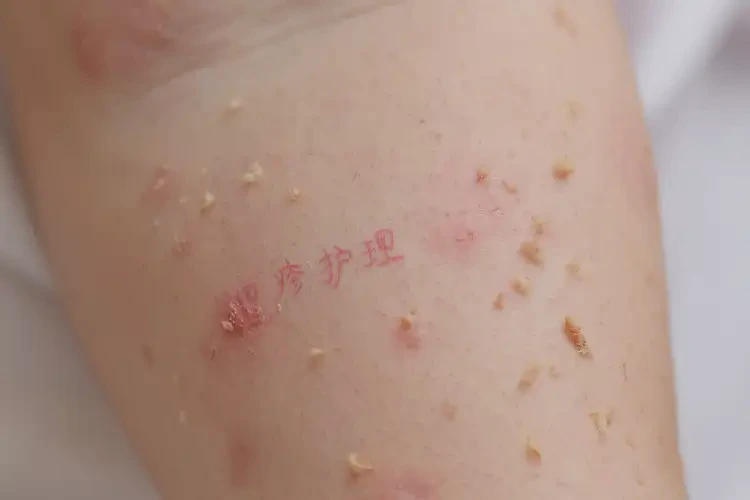 孩子全身偶爾長濕疹可不可以根治(圖4)