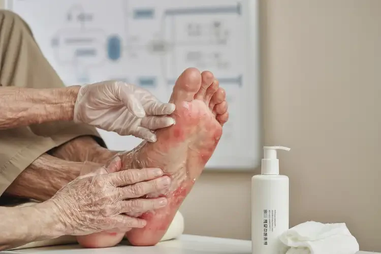 高齡老人腳上出濕疹可不可以徹底自愈(圖3)