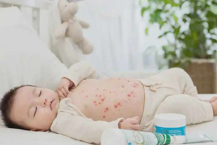 寶寶肚子上容易長濕疹可不可以根治(圖4)