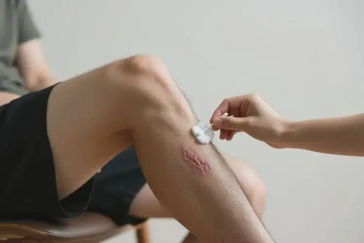 男生大腿上長濕疹不管它會自己好嗎(圖3)