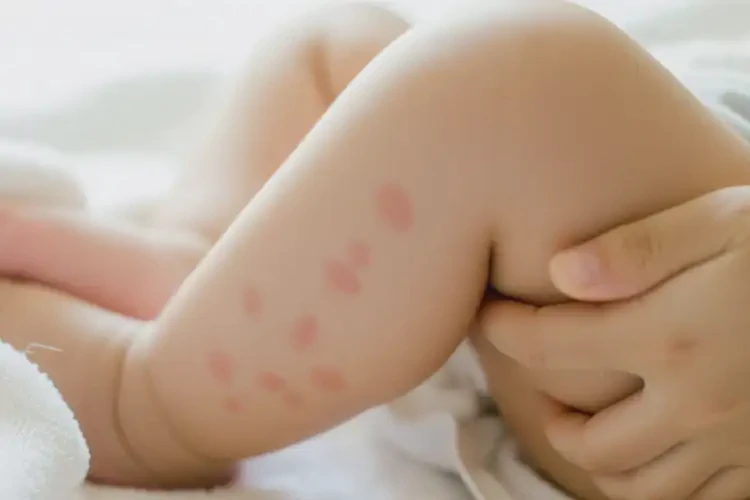 新生兒小腿上出現(xiàn)濕疹不管它會(huì)自己好嗎(圖4)