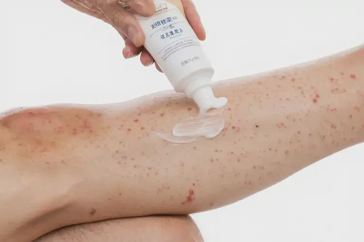 男人小腿上偶尔长湿疹能不能根治(图2)