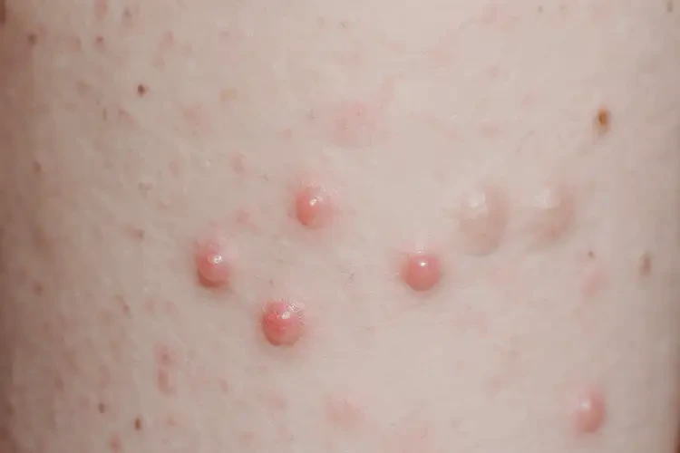 儿童四肢有湿疹能彻底自愈吗(图4)