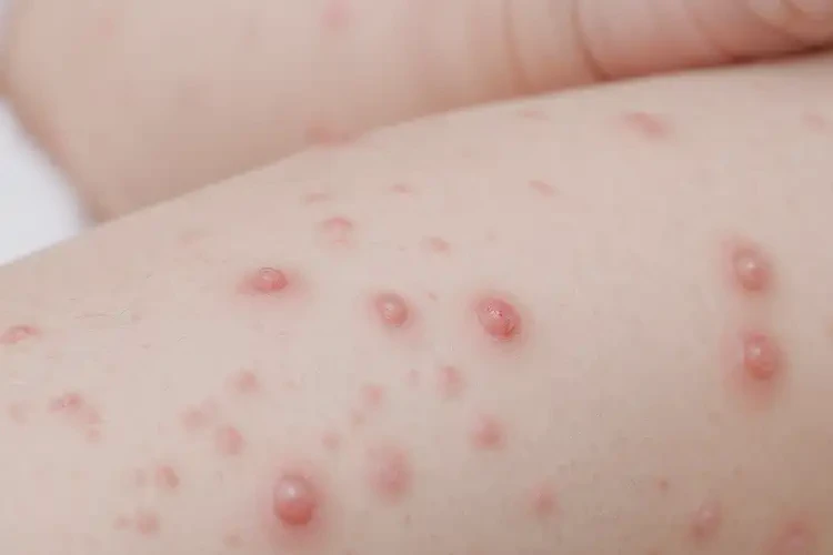 小兒屁股上容易起濕疹能夠徹底治愈嗎(圖4)