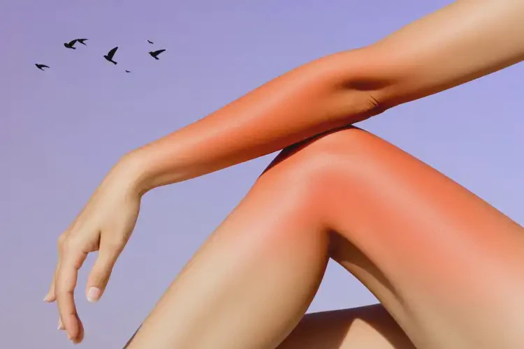 女性四肢長濕疹能靠自己自愈嗎(圖2)