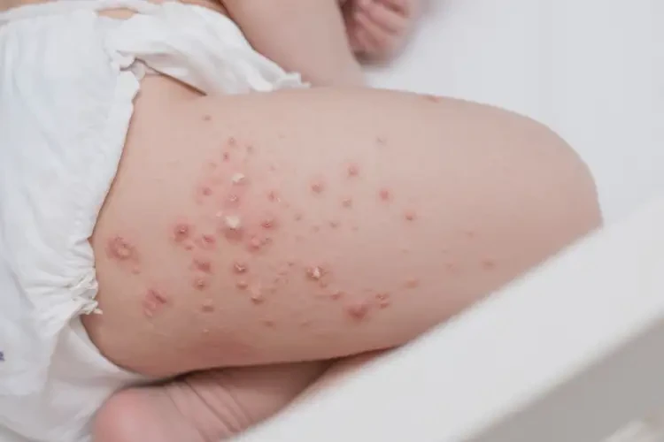 新生兒屁股上有濕疹能夠徹底治愈嗎(圖4)