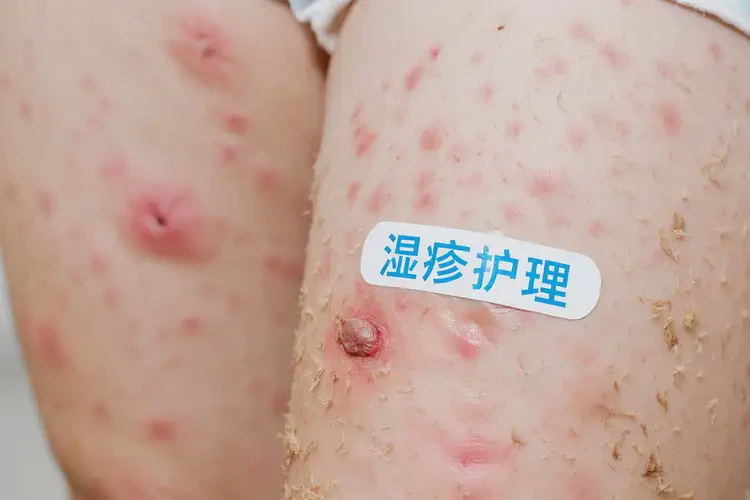 少兒大腿上出濕疹可不可以根治(圖4)