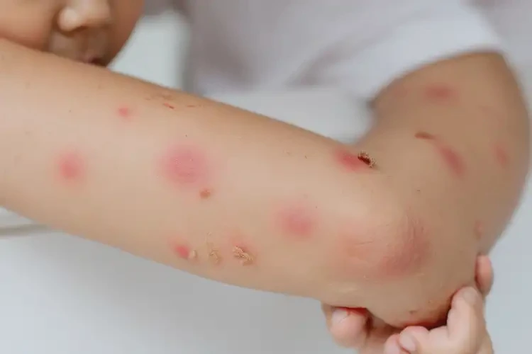 少兒手臂經(jīng)常長(zhǎng)濕疹能徹底自愈嗎(圖4)