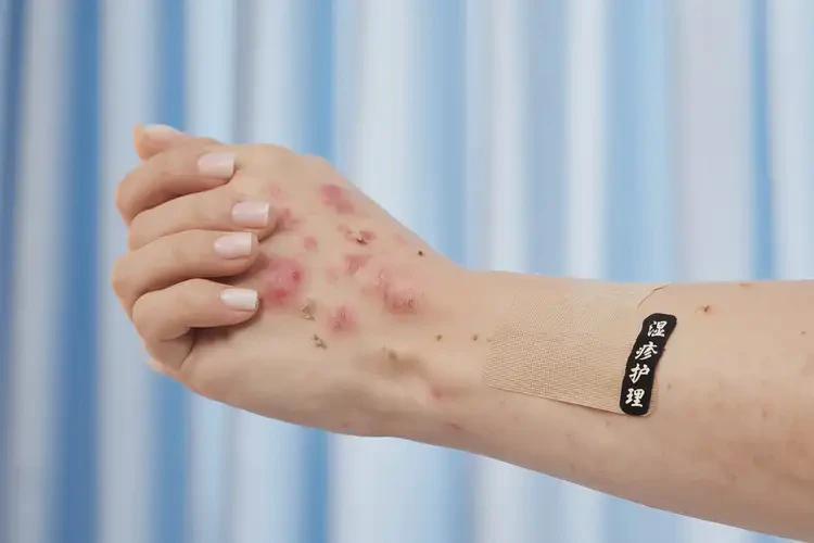 女生身上容易長濕疹能靠自己自愈嗎(圖4)