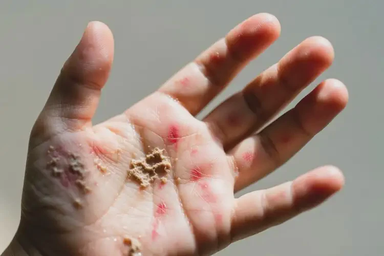 少兒手上有濕疹不管它會(huì)自己自愈嗎(圖2)