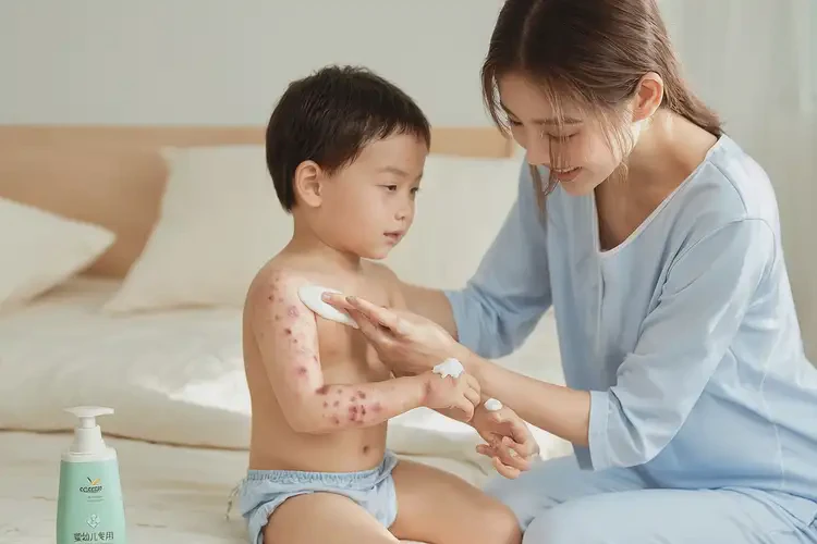 孩子脖子上起濕疹可不可以徹底自愈(圖3)