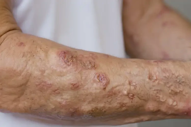 大學生小腿上經(jīng)常起濕疹不管它會自己自愈嗎(圖3)