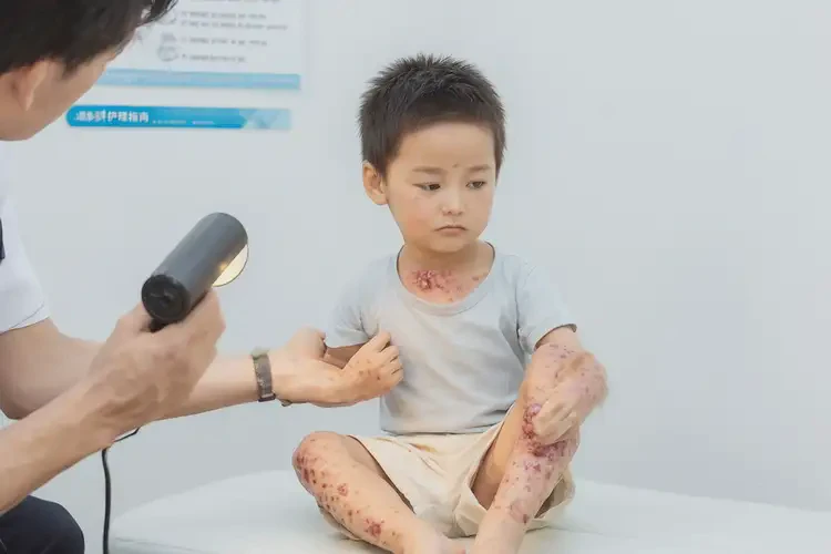 小孩全身出現(xiàn)濕疹不管它會自己痊愈嗎(圖4)